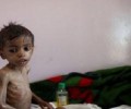 منظمة اليونيسيف: طفل يمني دون سن الخامسة يموت كل عشر دقائق